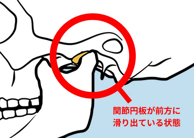 顎関節症